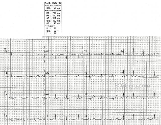 Normal 12 Lead ECG Tracing